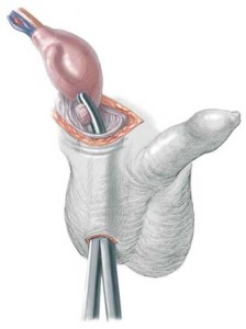 Descida e fixação do testículo à bolsa escrotal