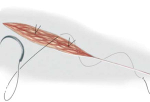 A sutura da pele é realizada com ponto intradérmico, usando fio absorvível ou retirável em 7 a 10 dias