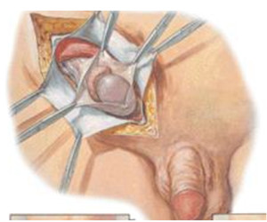 No caso da hidrocele o testículo é elevado até a incisão inguinal e a túnica vaginal deve ser aberta para liberar o líquido e evitar que volte a acumular