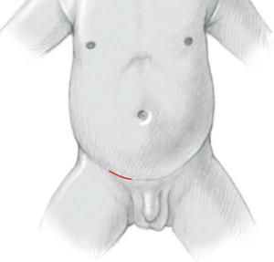 Sob anestesia geral, é realizada uma incisão pequena na região inguinal, geralmente sobre a prega natural inferior do abdome