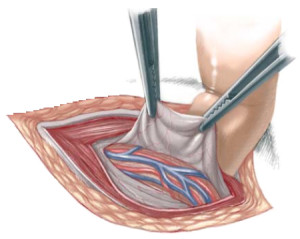 Após a abertura das diferentes camadas, identifica-se o saco herniário (persistência do processo vaginal) no interior do canal inguinal, junto ao cordão espermático nos meninos e ao ligamento redondo nas meninas