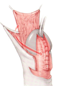 A linha de sutura da neouretra recebe reforço de tecido vizinho como o dartos (figura) ou a túnica vaginal. Essa proteção diminui a incidência de fístulas