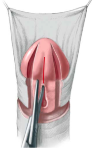 Após a incisão na glande e no prepúcio a placa que será usada para reconstrução da uretra é incisada medialmente para ampliar seu diâmetro e, consequentemente garantir um maior calibre à neouretra tubularizada
